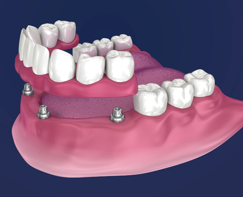 All-on-4 Dental Implants