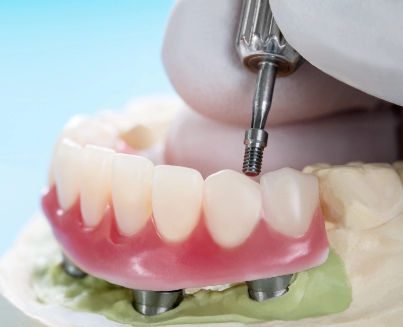 All-on-X Dental Implants