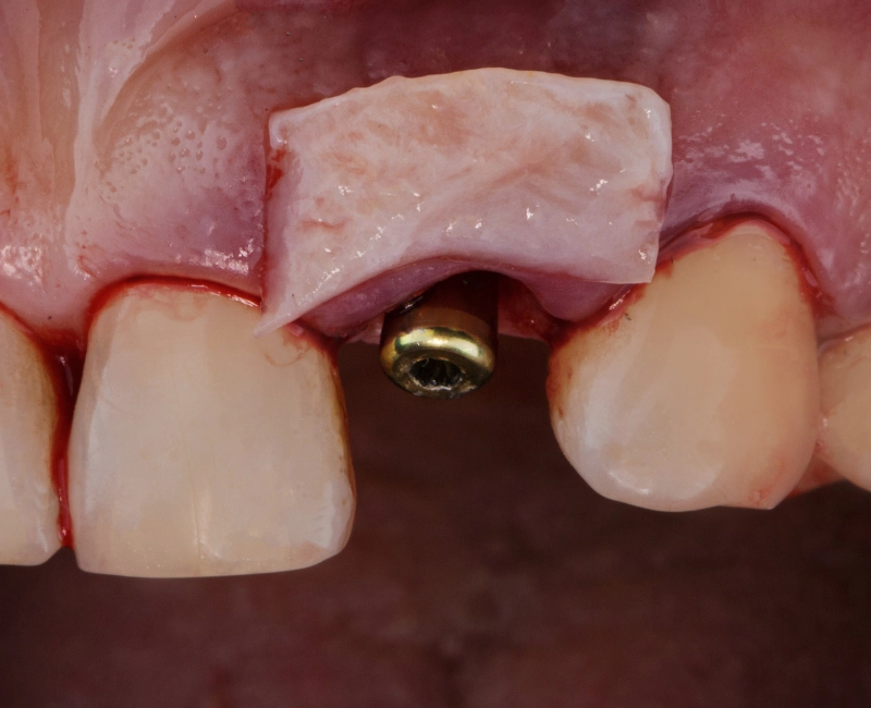 Bone Grafting