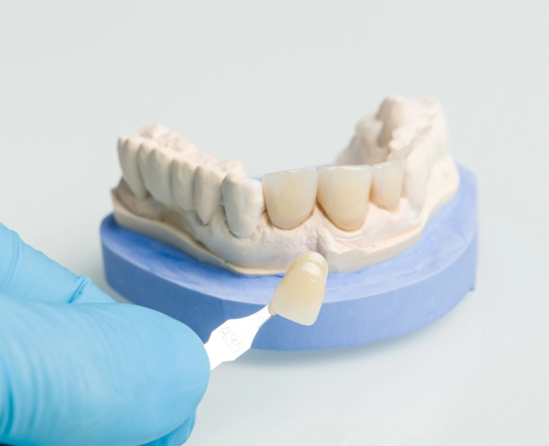 CEREC® Crowns