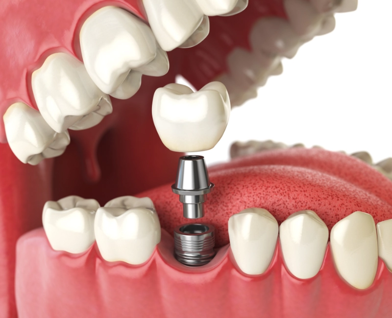 Dental Implants