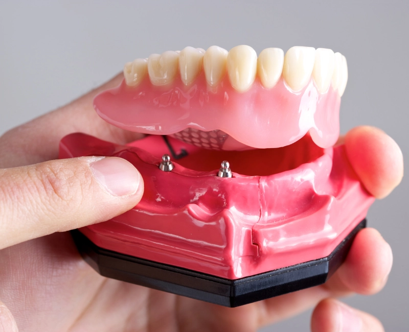 Implant-supported dentures