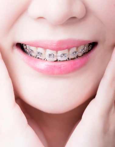 Metal Braces