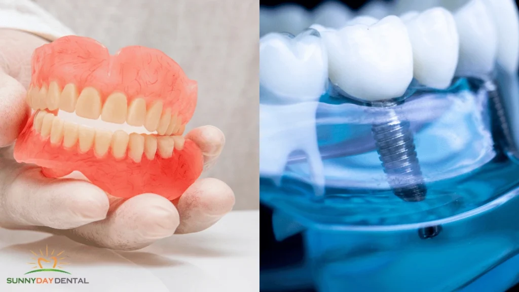 Dental Implants vs Dentures