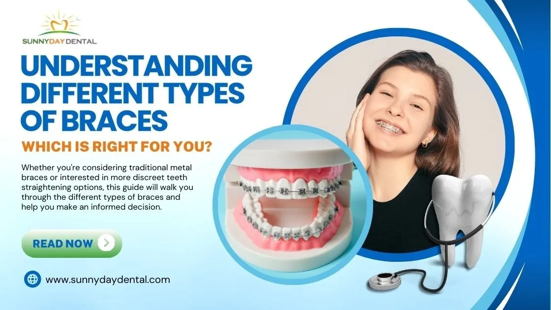 Understanding Different Types of Braces