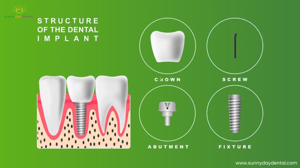 What Are Dental Implants