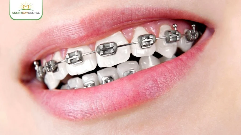 Self-Ligating Braces