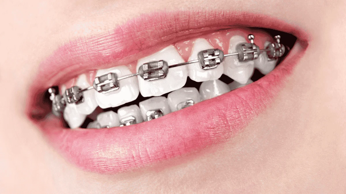 Metal braces