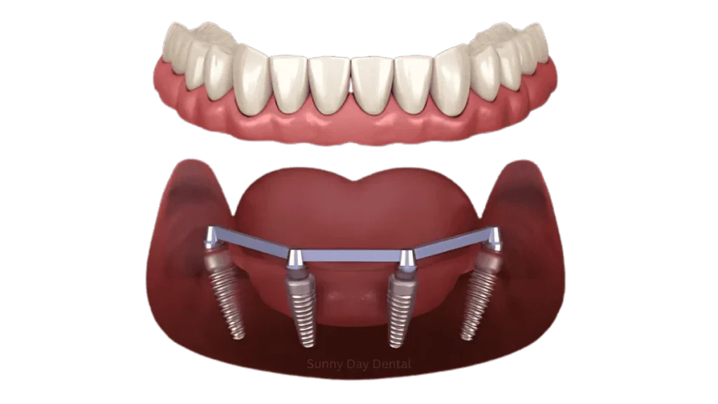 4 Dental Implants