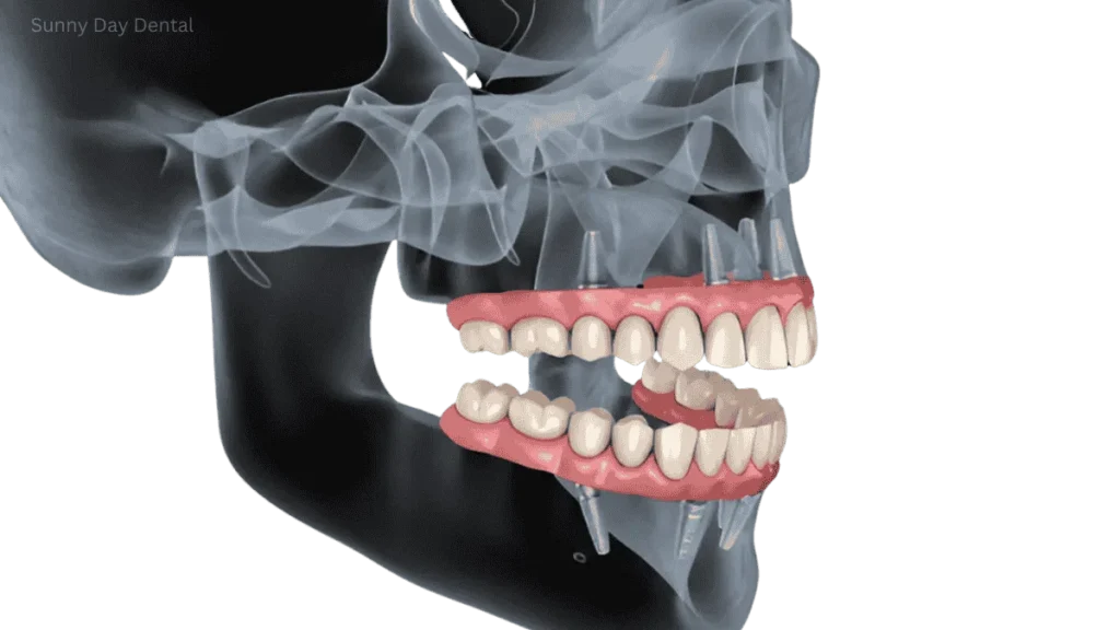 4 Dental Implants Work