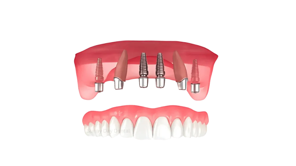 All on X Dental Implants