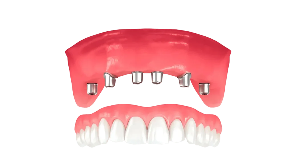 Process of All on X Dental Implants