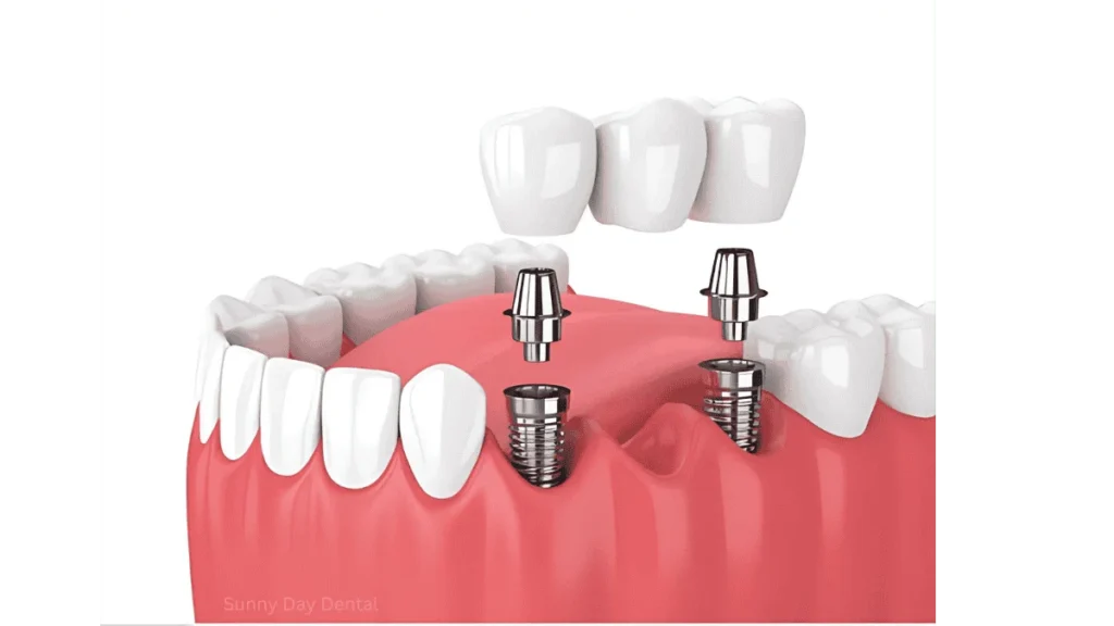 Implant Supported Bridges