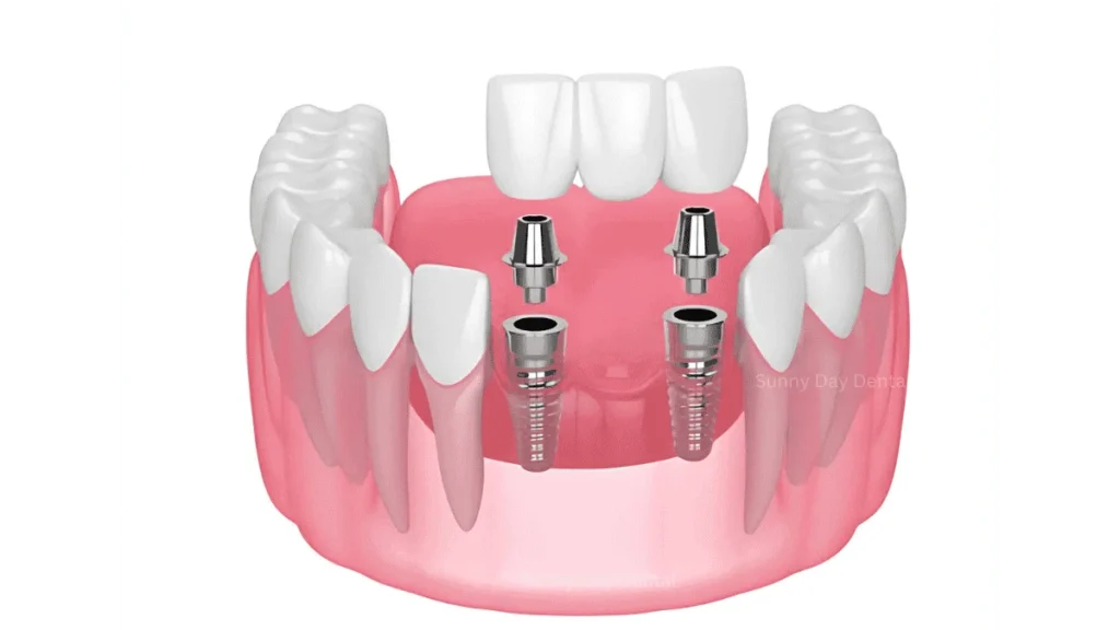 Implant Supported Bridges