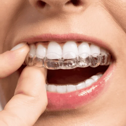 Teeth Aligners