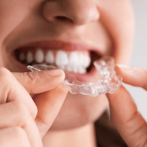 Clear Aligners