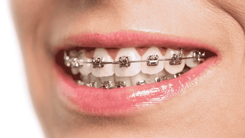 Metal Braces in Woodbridge