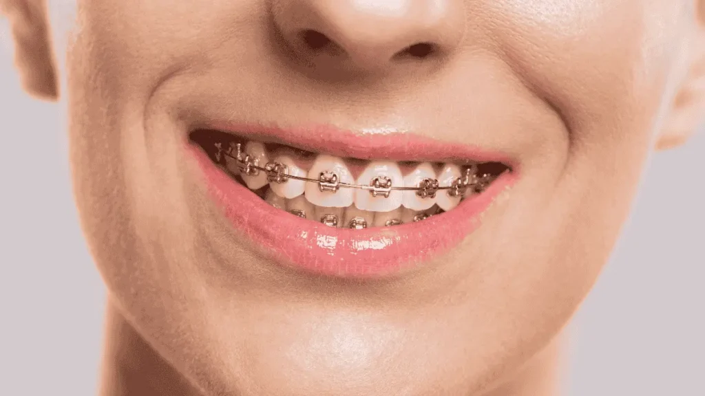 Traditional Braces