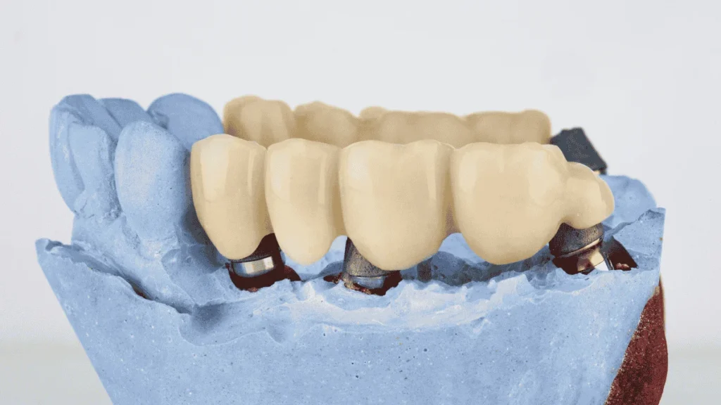 Dental Bridge