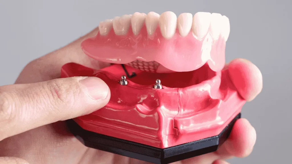 Implant-Supported Dentures