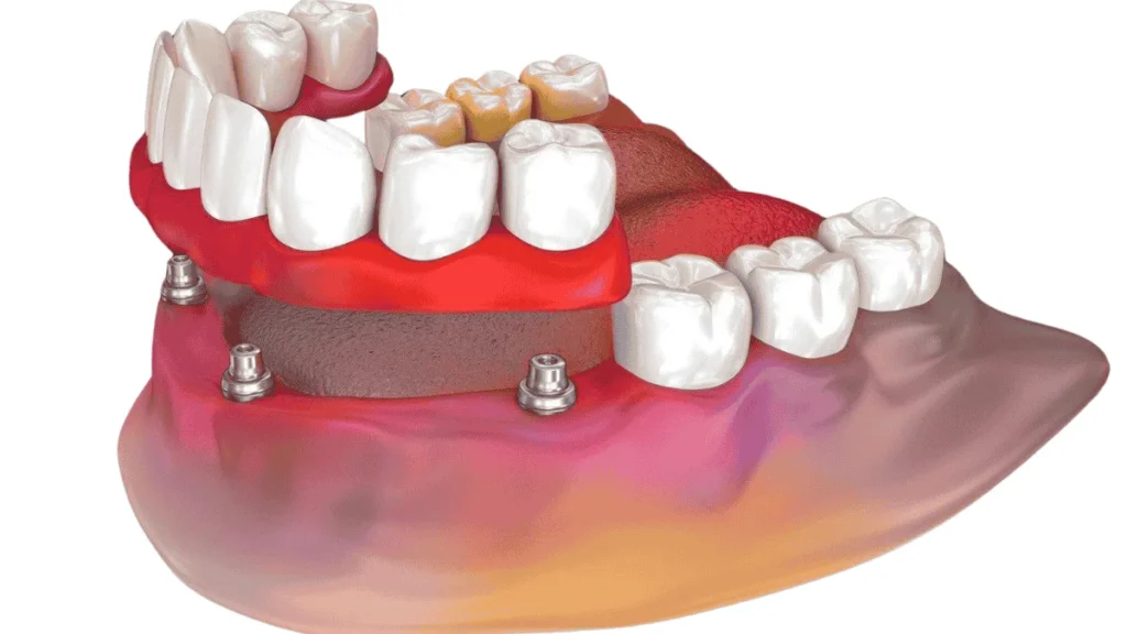 Implant-Supported Dentures Process