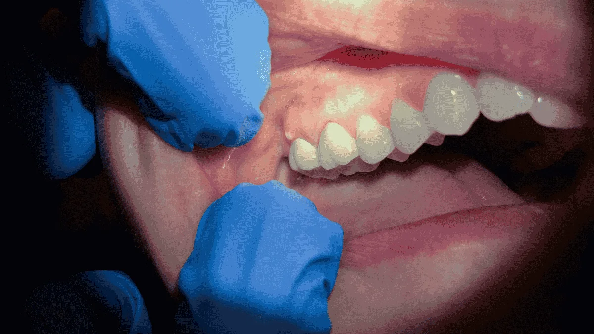 Dental Abscesses