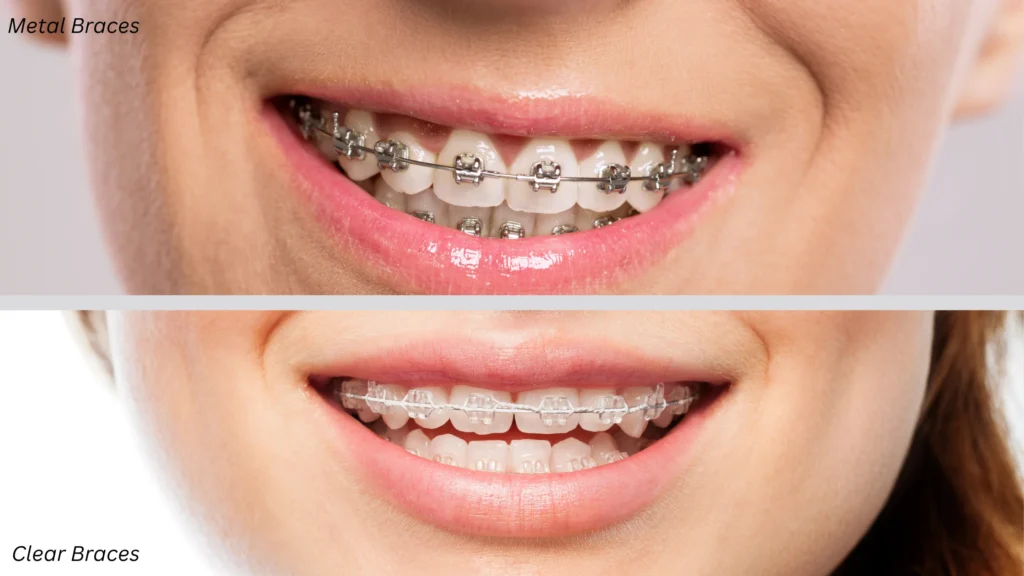 Clear vs Metal Braces