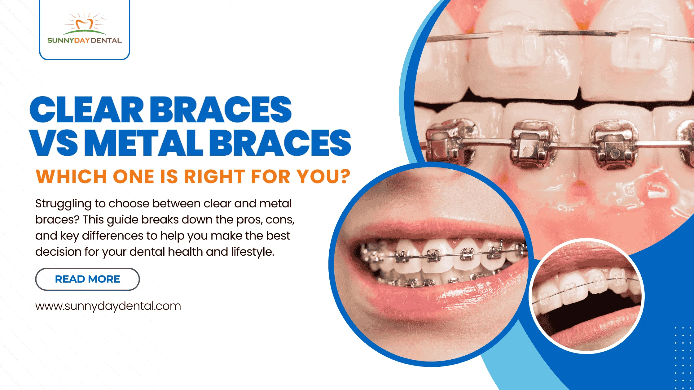 clear vs metal braces