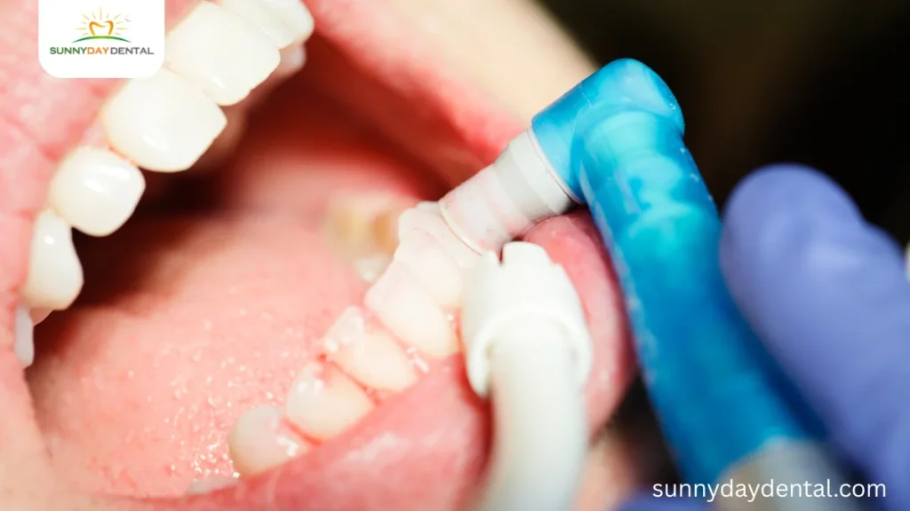 Dental Cleanings So Important
