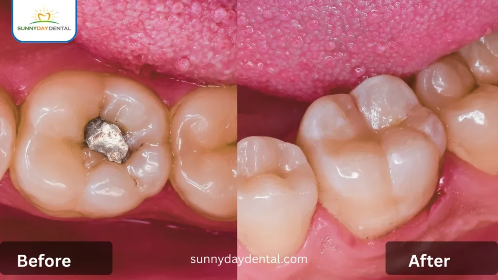 Amalgam Fillings