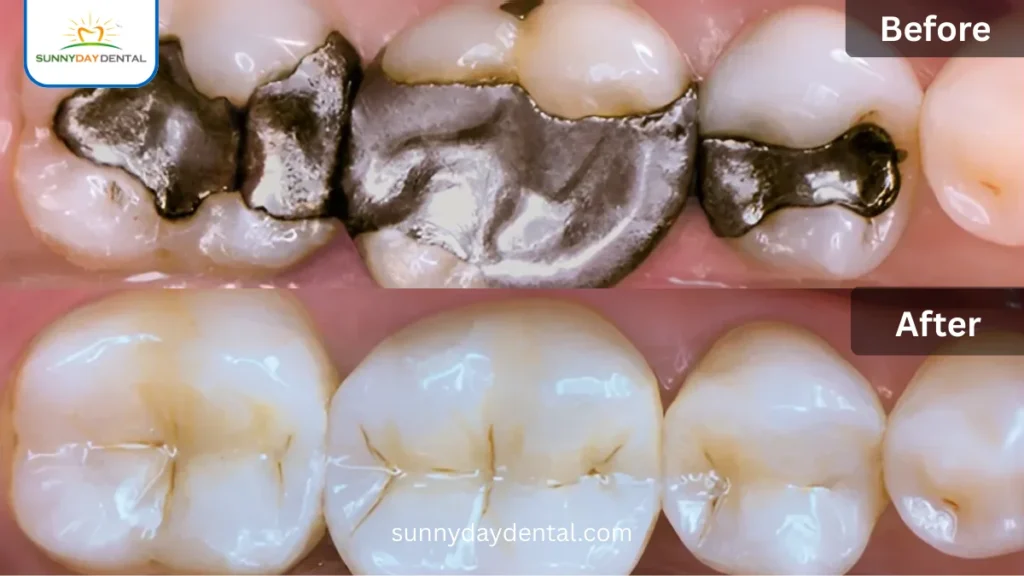 Composite Resin Fillings