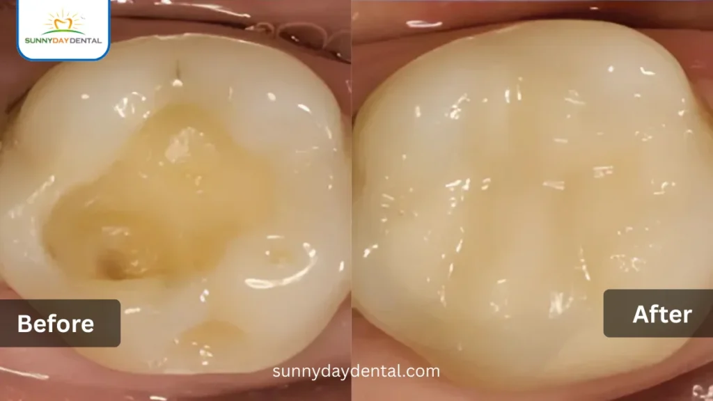 Glass Ionomer Fillings