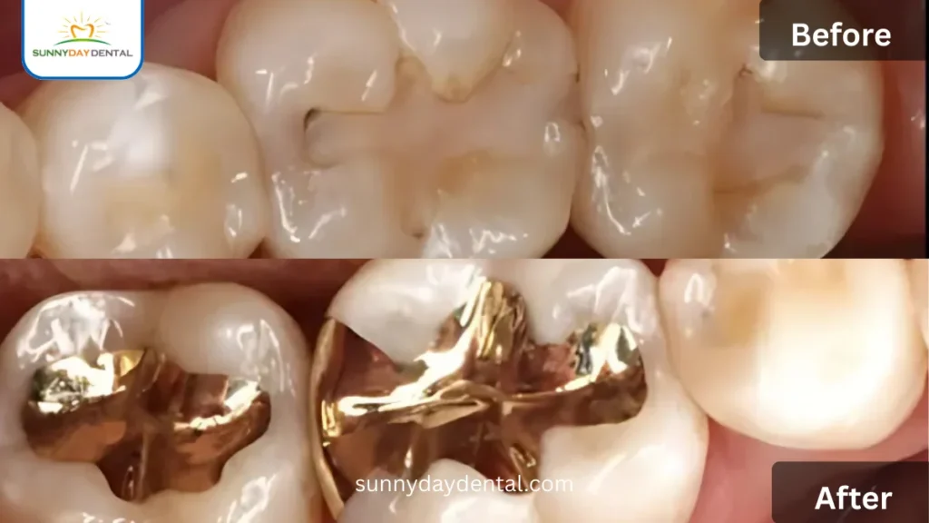 Gold Fillings