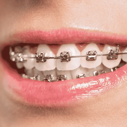 Traditional braces