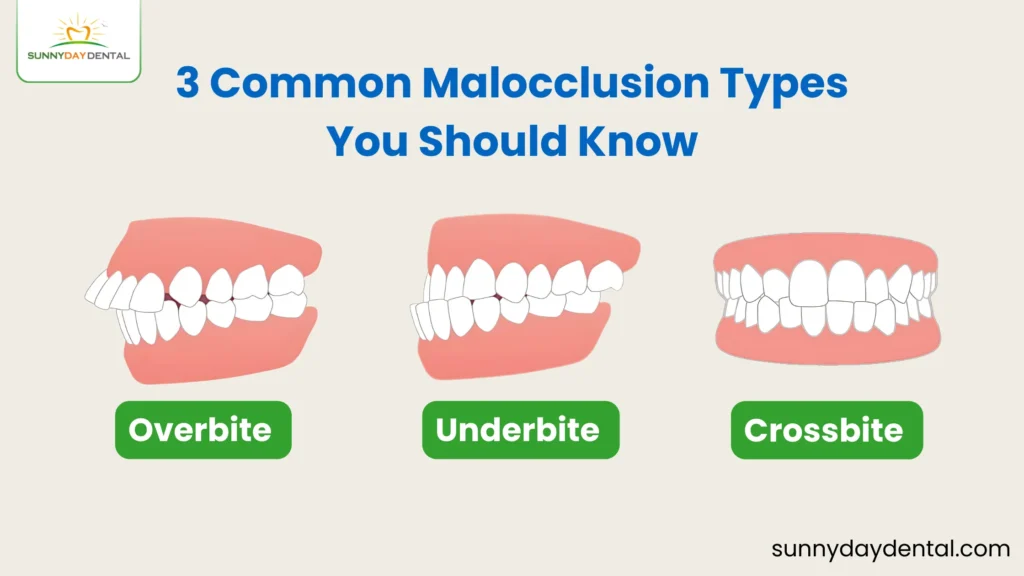 3 Common Malocclusion Types