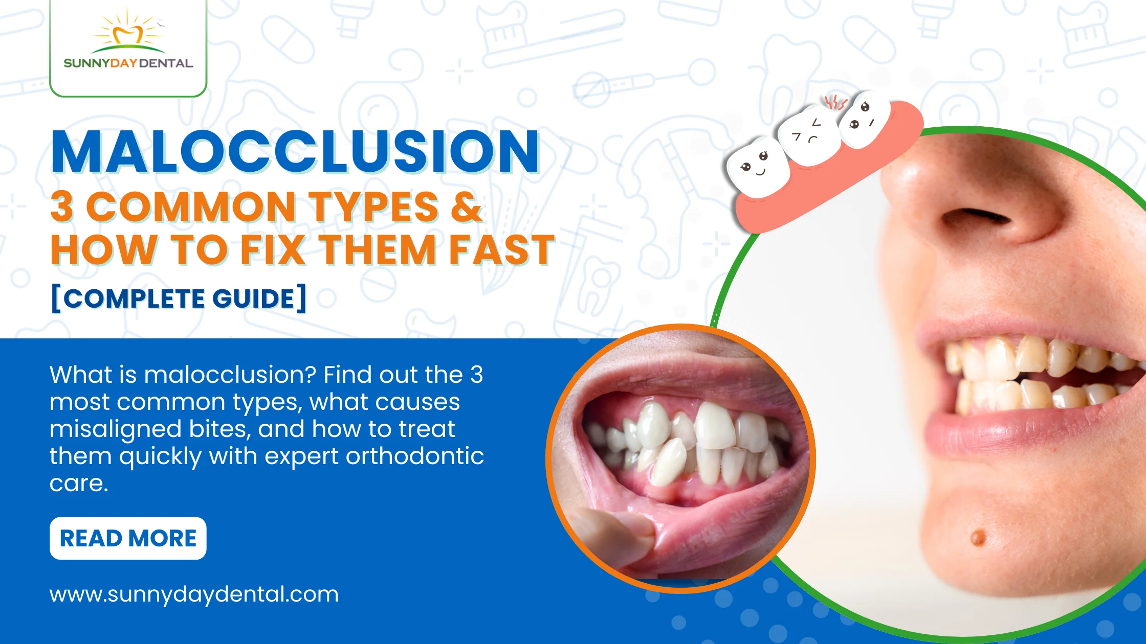 Malocclusion