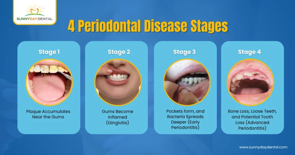 4 Periodontal Disease Stages