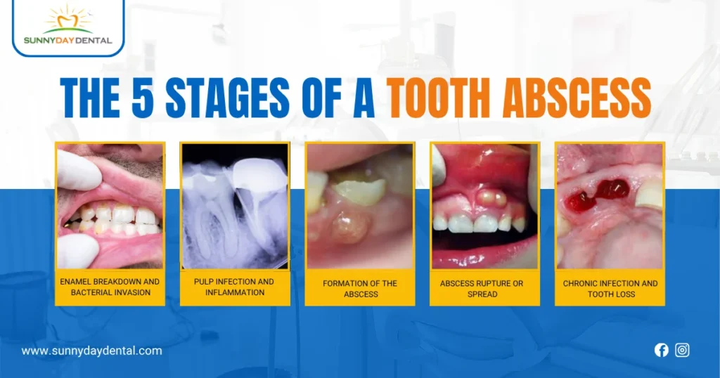 5 Stages of a Tooth Abscess