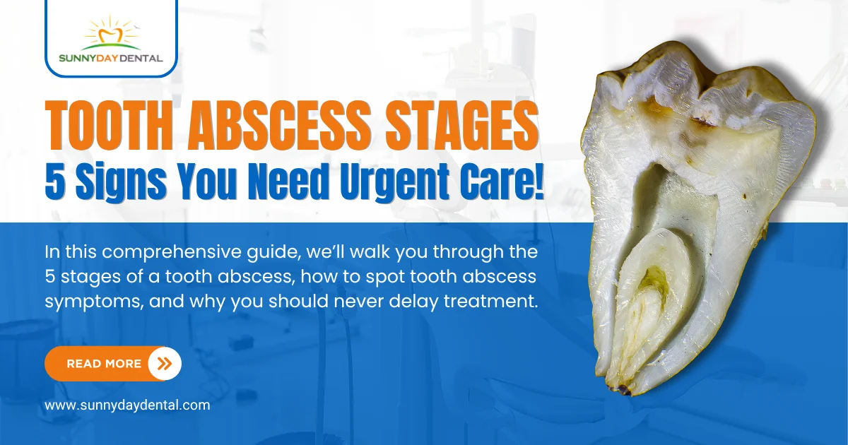Tooth Abscess