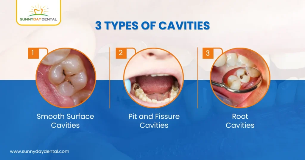 3 Types of Cavities