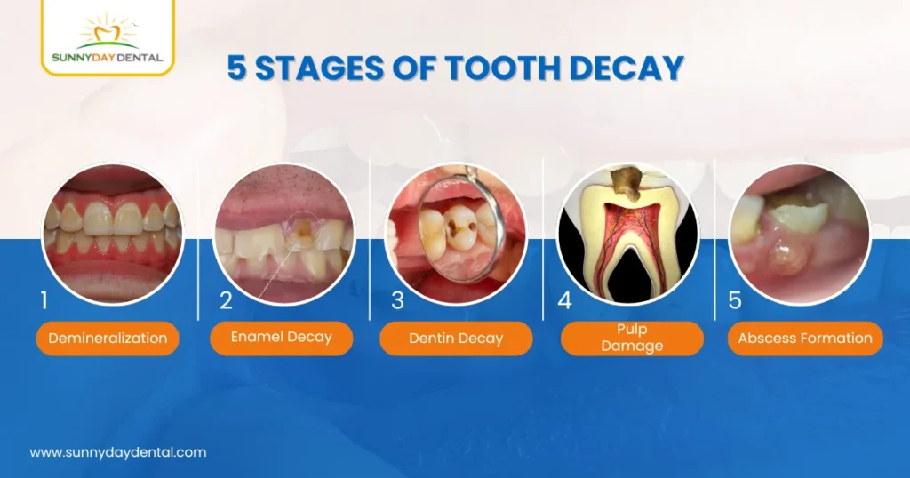 5 Stages of Tooth Decay