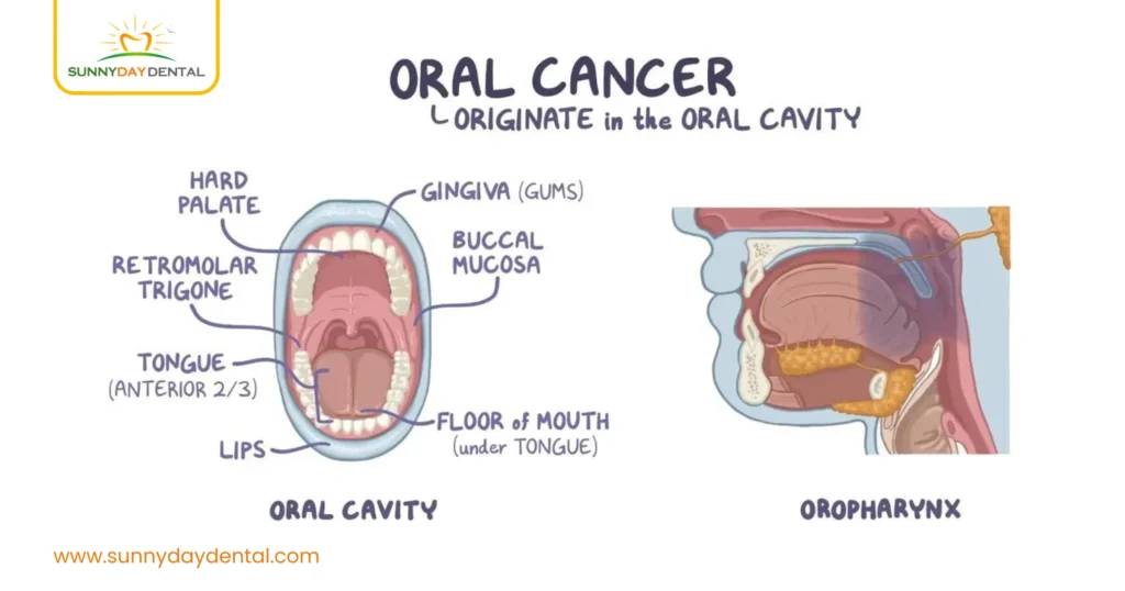What is Oral Cancer