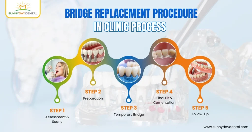  Bridge Replacement Procedure – In Clinic Process 