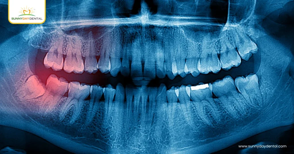 Impacted Wisdom Teeth