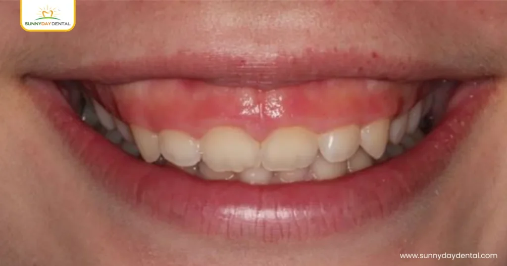 Deep Bite Excessive Vertical Overlap of Front Teeth