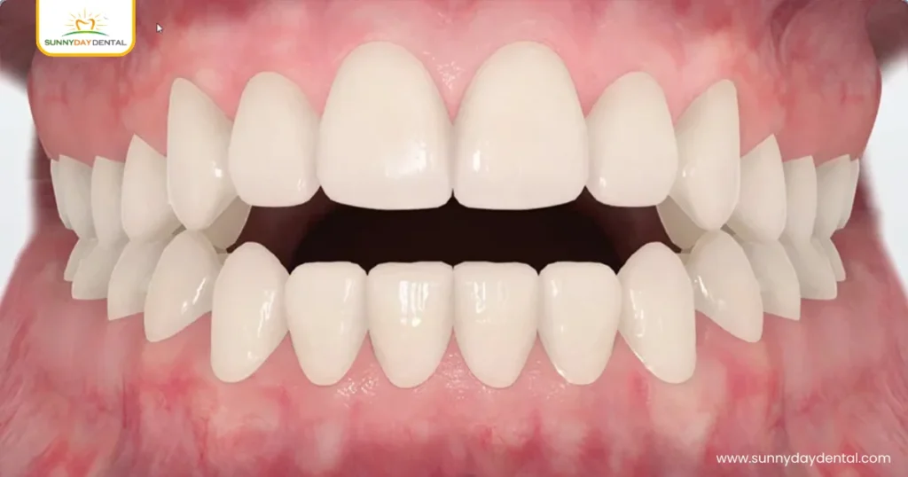 Open Bite Why Won’t My Front Teeth Touch