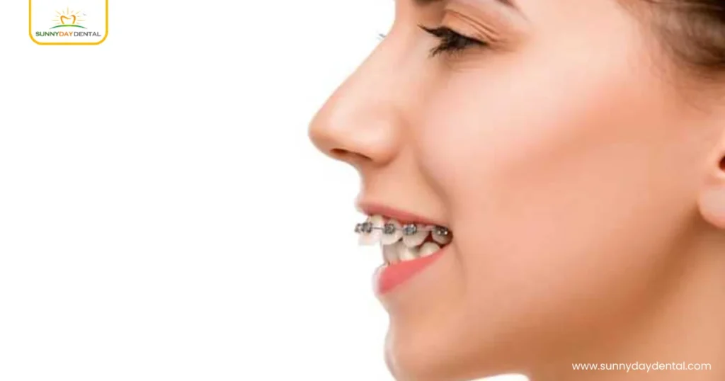 Overjet Protruding Upper Front Teeth