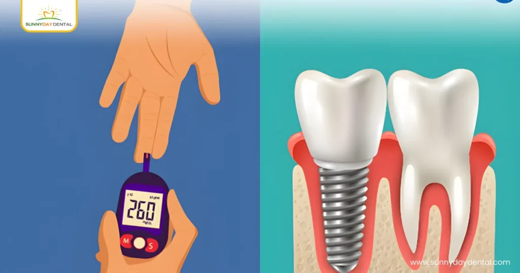 How Dental Implants Work in Diabetic Patients