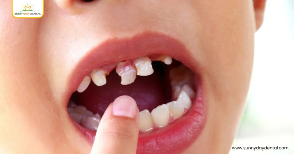 The Role of Diet in Preventing Tooth Decay in Children