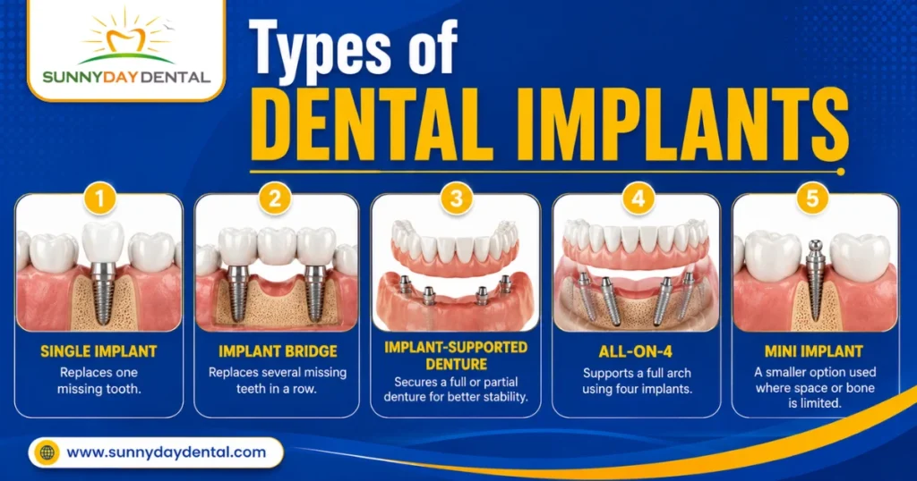 Types of Dental Implants